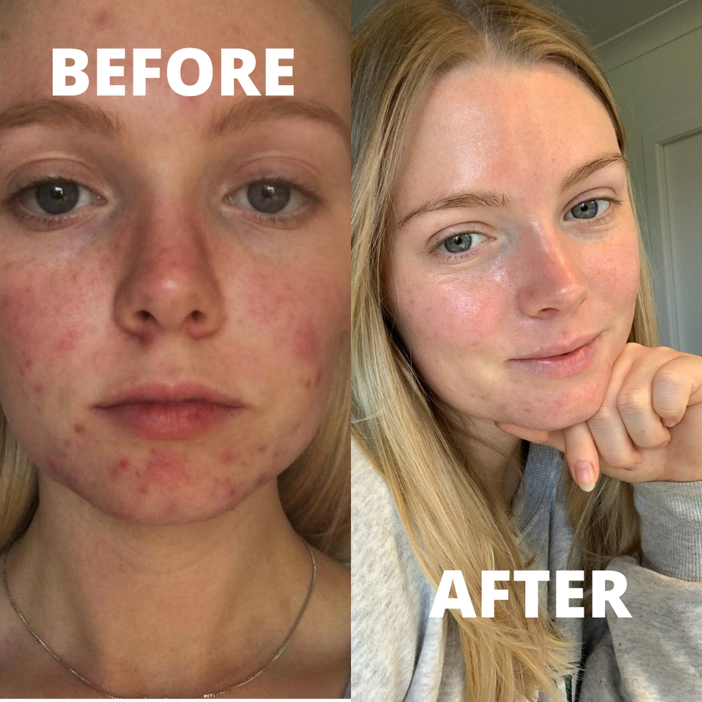Blemish Rescue Serum